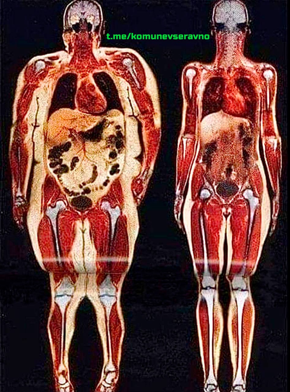 Висцеральный жир анатомия. Висцеральный жир на рентгене. Ожирение висцеральный жир. Широкая кость.