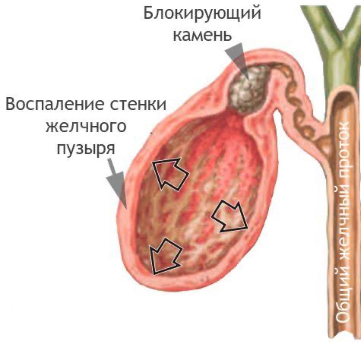 Эхопризнаки холецистита. Острый бескаменный холецистит. Холецистит желчного пузыря. Острый катаральный холецистит. Острое воспаление желчного пузыря.